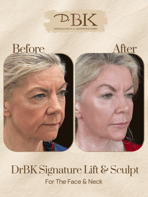 27 Before and after image of DrBK Signature Non-Surgical Facelift with Threads