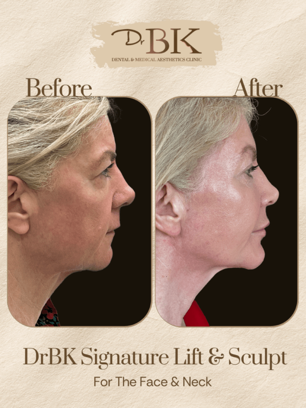 28 Before and after image of DrBK Signature Non-Surgical Facelift with Threads