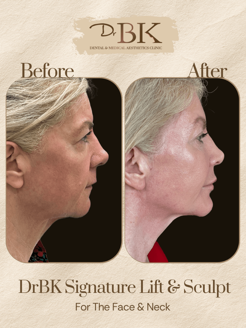 28 Before and after image of DrBK Signature Non-Surgical Facelift with Threads