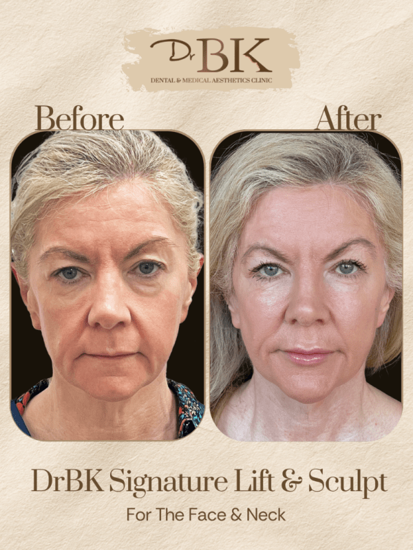 29 Before and after image of DrBK Signature Non-Surgical Facelift with Threads