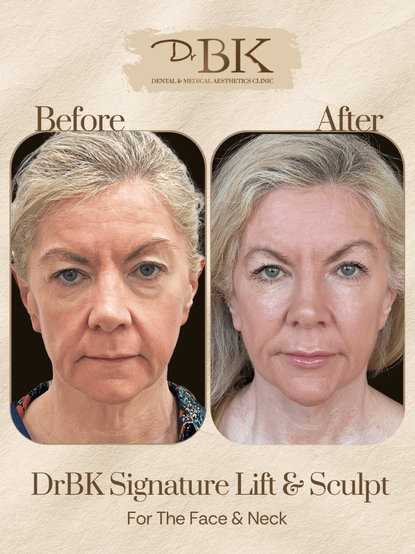 29 Before and after image of DrBK Signature Non-Surgical Facelift with Threads