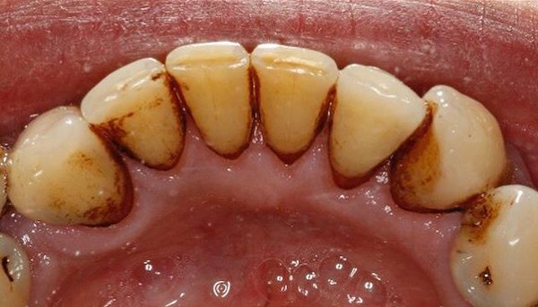 Before Hygiene Appointment in Reading (DrBK Reading) Hygiene Appointments in Reading (DrBK Reading)