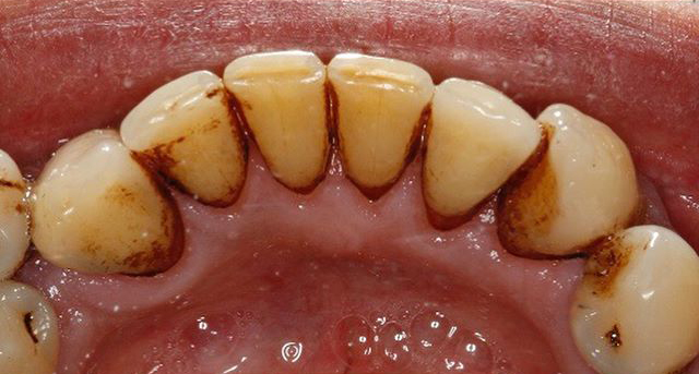 Before Hygiene Appointment in Reading (DrBK Reading) Hygiene Appointments in Reading (DrBK Reading)