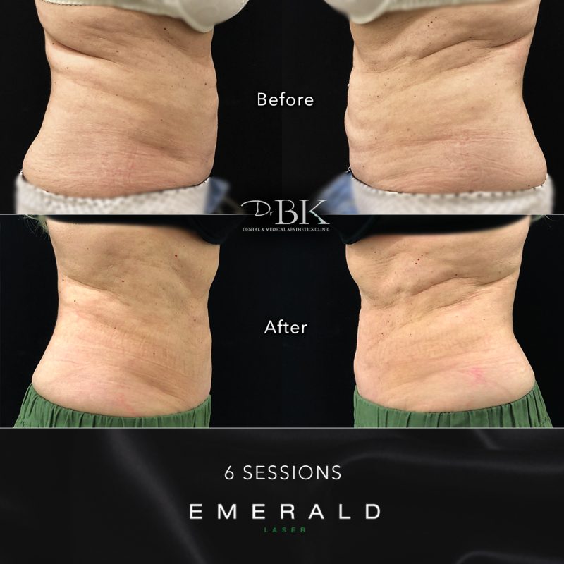Emerald Fat Loss Laser at DrBK - Before & Afters Emerald Fat Loss Laser at DrBK - Before & Afters