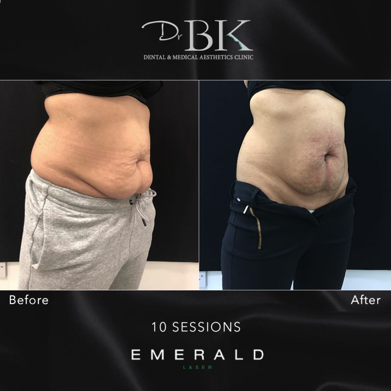 Emerald Fat Loss Laser at DrBK - Before & Afters Emerald Fat Loss Laser at DrBK - Before & Afters