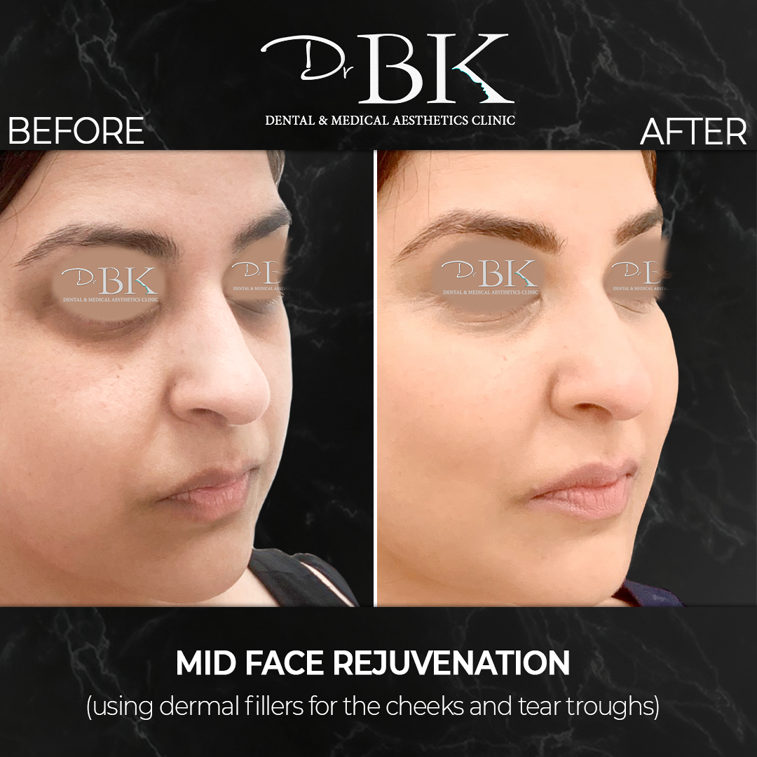 Before & After Tear Trough & Cheek Sculpting Before & After Tear Trough & Cheek Sculpting