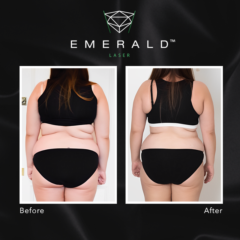 Emerald Fat Loss Laser - Before and After Emerald Fat Loss Laser - Before and After
