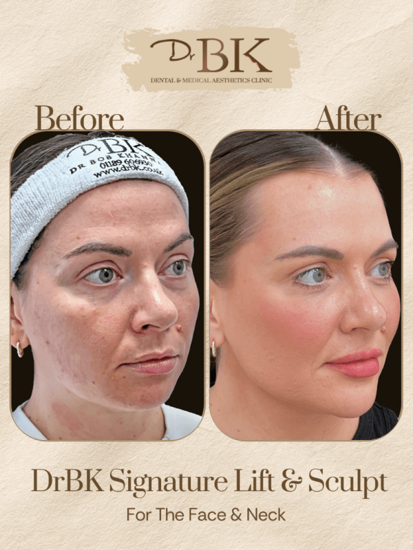 30 Before and after image of DrBK Signature Non-Surgical Facelift with Threads