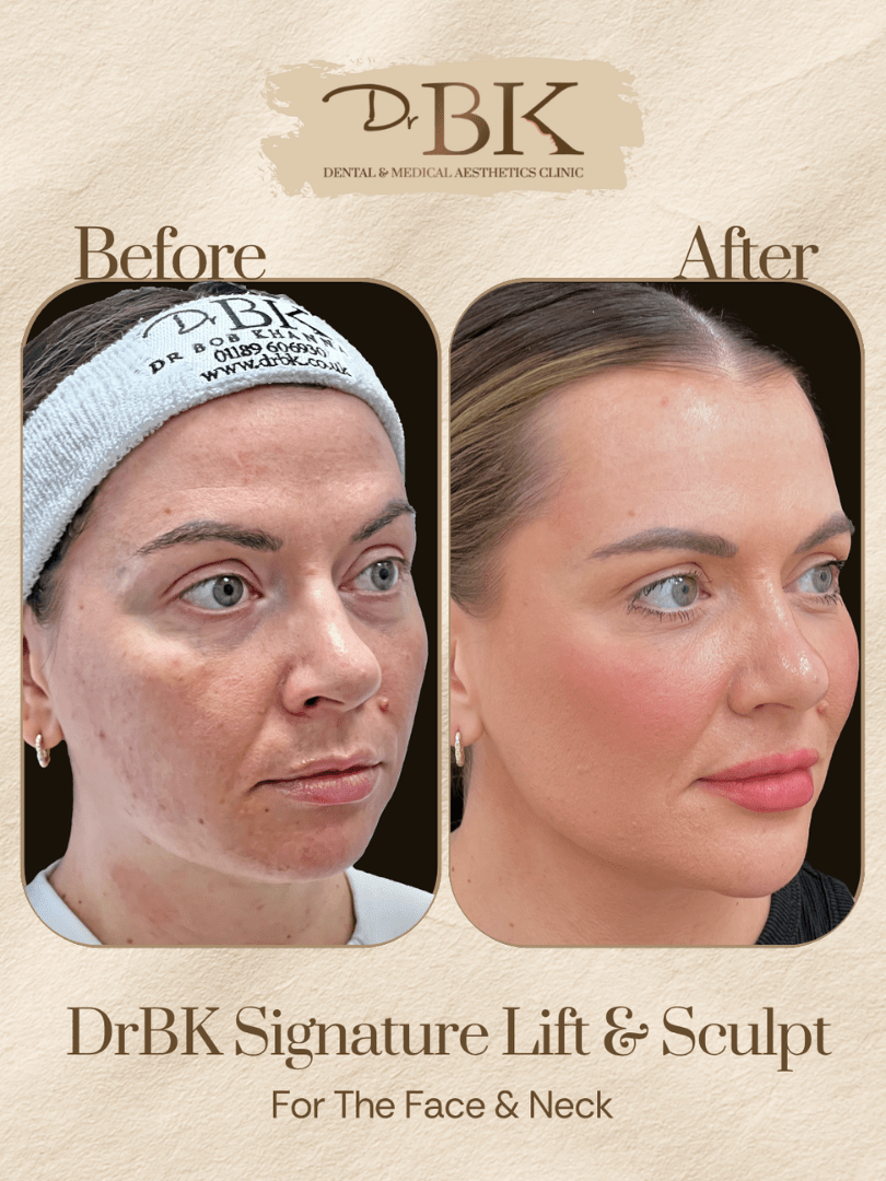 30 Before and after image of DrBK Signature Non-Surgical Facelift with Threads