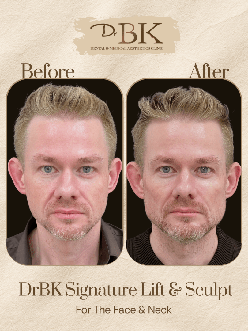 31 Before and after image of DrBK Signature Non-Surgical Facelift with Threads
