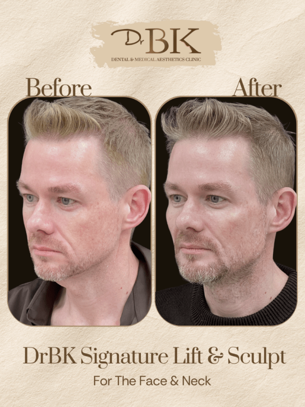 32 Before and after image of DrBK Signature Non-Surgical Facelift with Threads