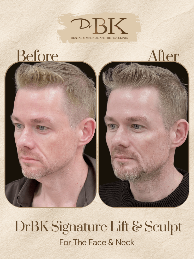 32 Before and after image of DrBK Signature Non-Surgical Facelift with Threads