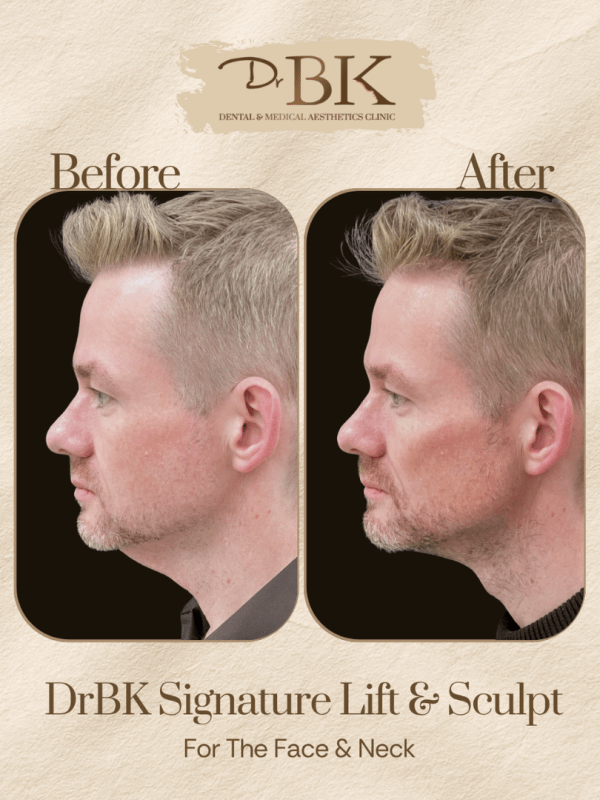 33 Before and after image of DrBK Signature Non-Surgical Facelift with Threads
