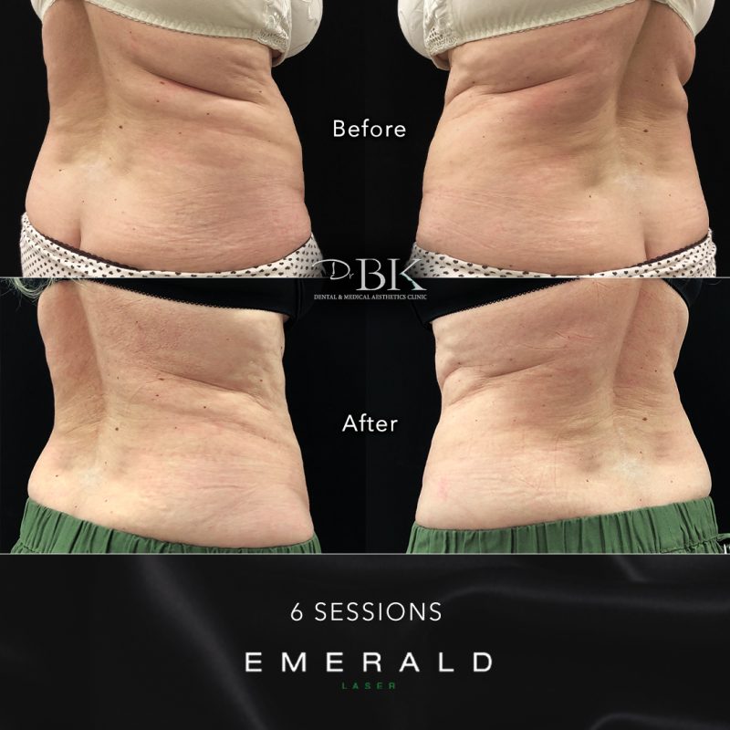 Emerald Fat Loss Laser at DrBK - Before & Afters Emerald Fat Loss Laser at DrBK - Before & Afters