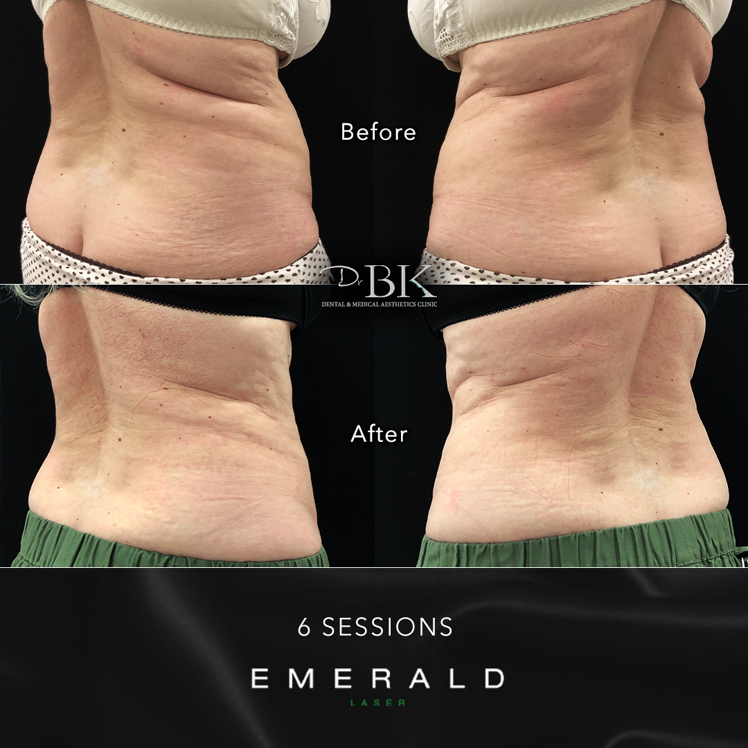 Emerald Fat Loss Laser at DrBK - Before & Afters Emerald Fat Loss Laser at DrBK - Before & Afters