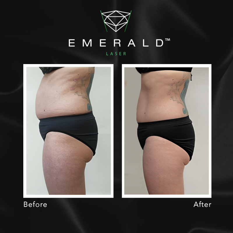Emerald Fat Loss Laser - Before and After Emerald Fat Loss Laser - Before and After