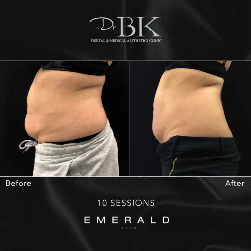Emerald Fat Loss Laser at DrBK - Before & Afters Emerald Fat Loss Laser at DrBK - Before & Afters