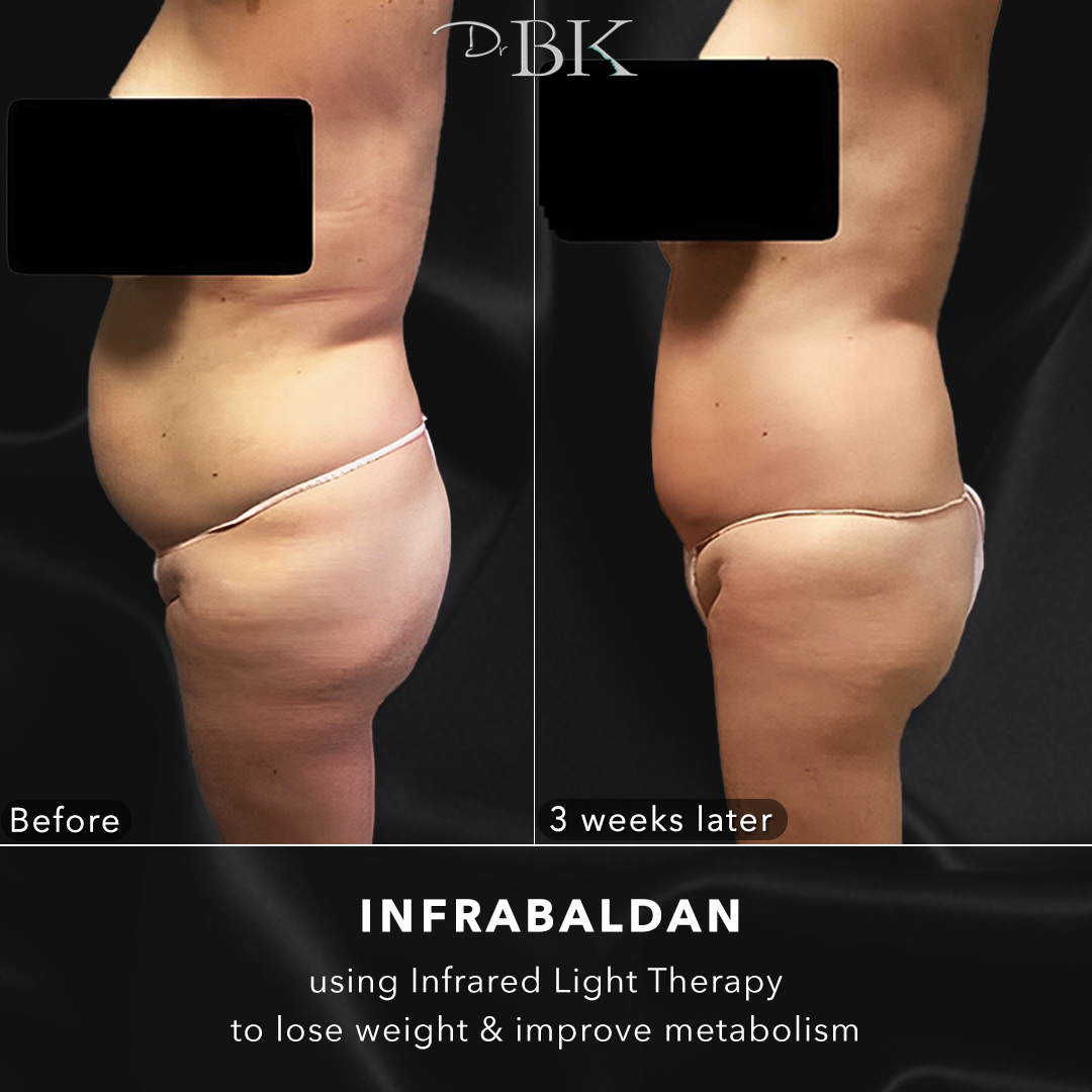 InfraBaldan laser treatment for fat loss - Photo showing patient with 5.2kg loss in 3 weeks