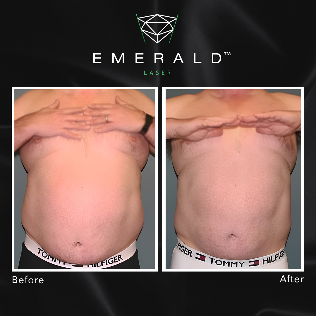 Emerald Fat Loss Laser - Before and After Emerald Fat Loss Laser - Before and After