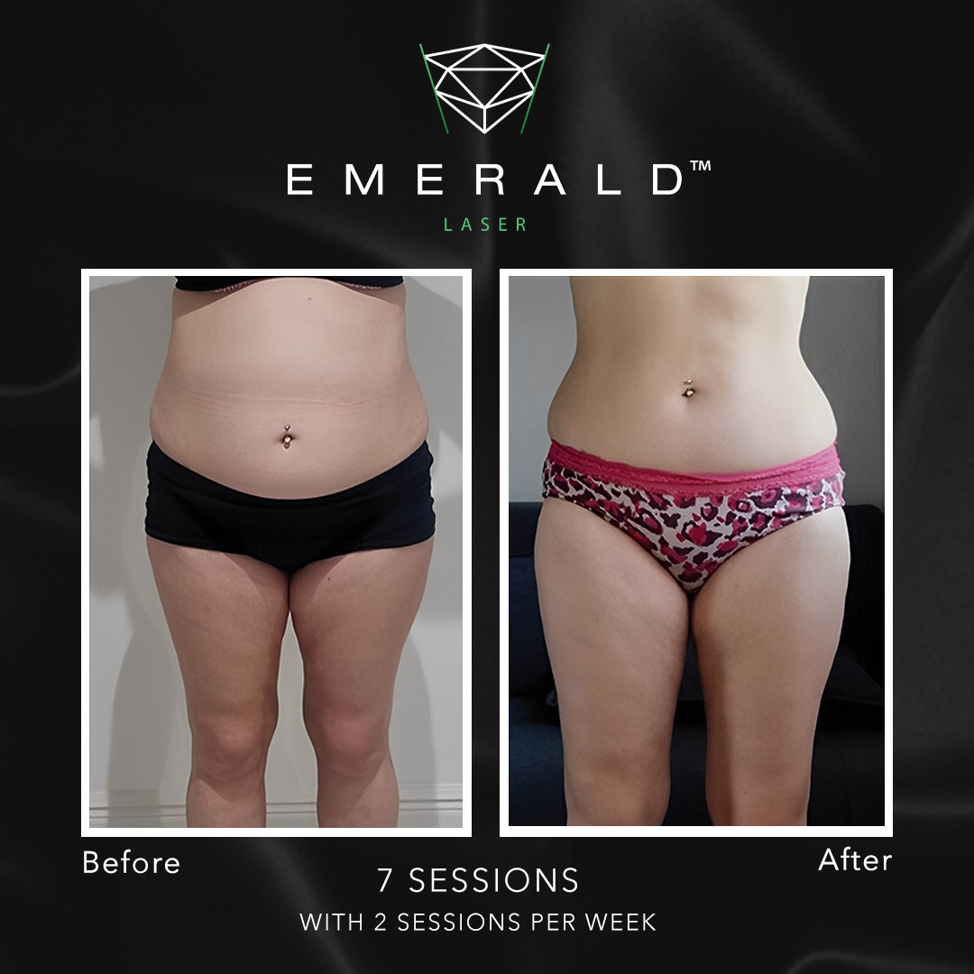 Emerald Fat Loss Laser - Before and After Emerald Fat Loss Laser - Before and After
