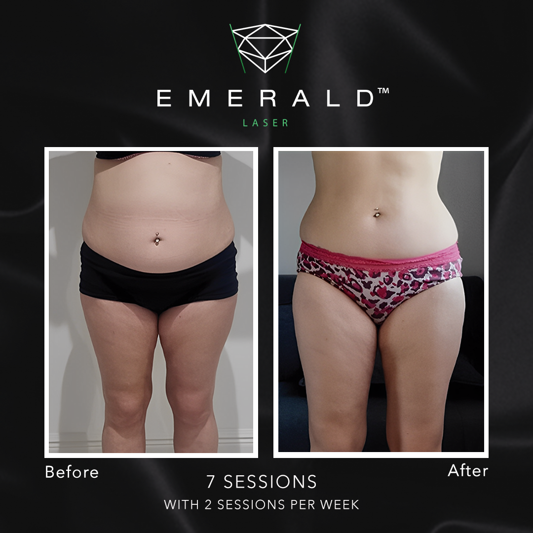 Emerald Fat Loss Laser - Before and After