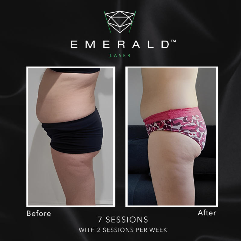 Emerald Fat Loss Laser - Before and After Emerald Fat Loss Laser - Before and After