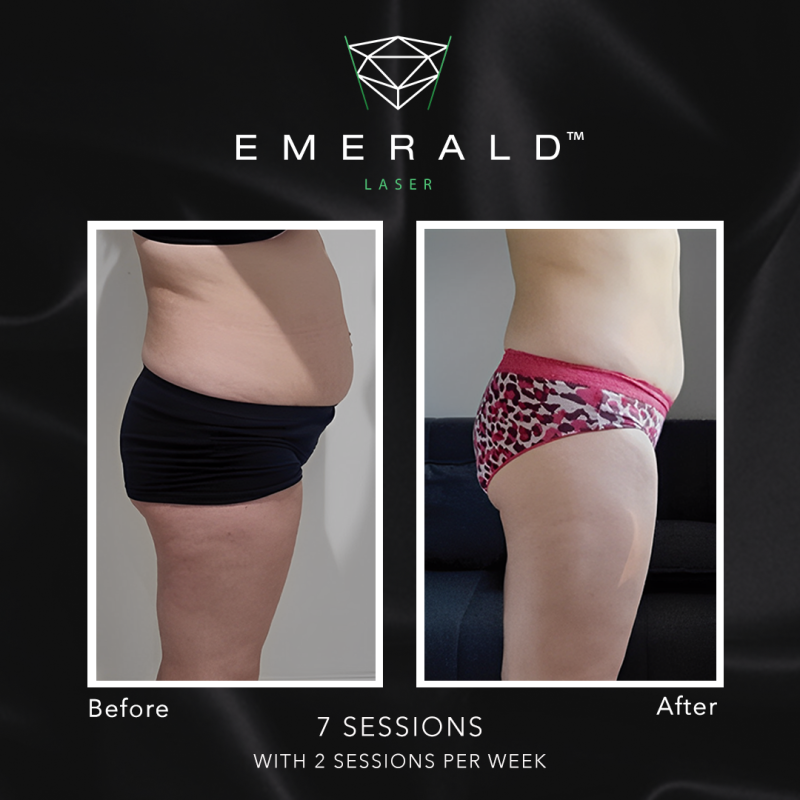 Emerald Fat Loss Laser - Before and After Emerald Fat Loss Laser - Before and After
