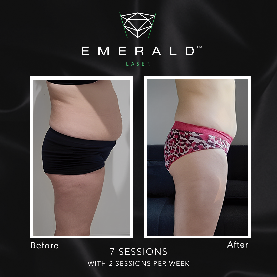 Emerald Fat Loss Laser - Before and After