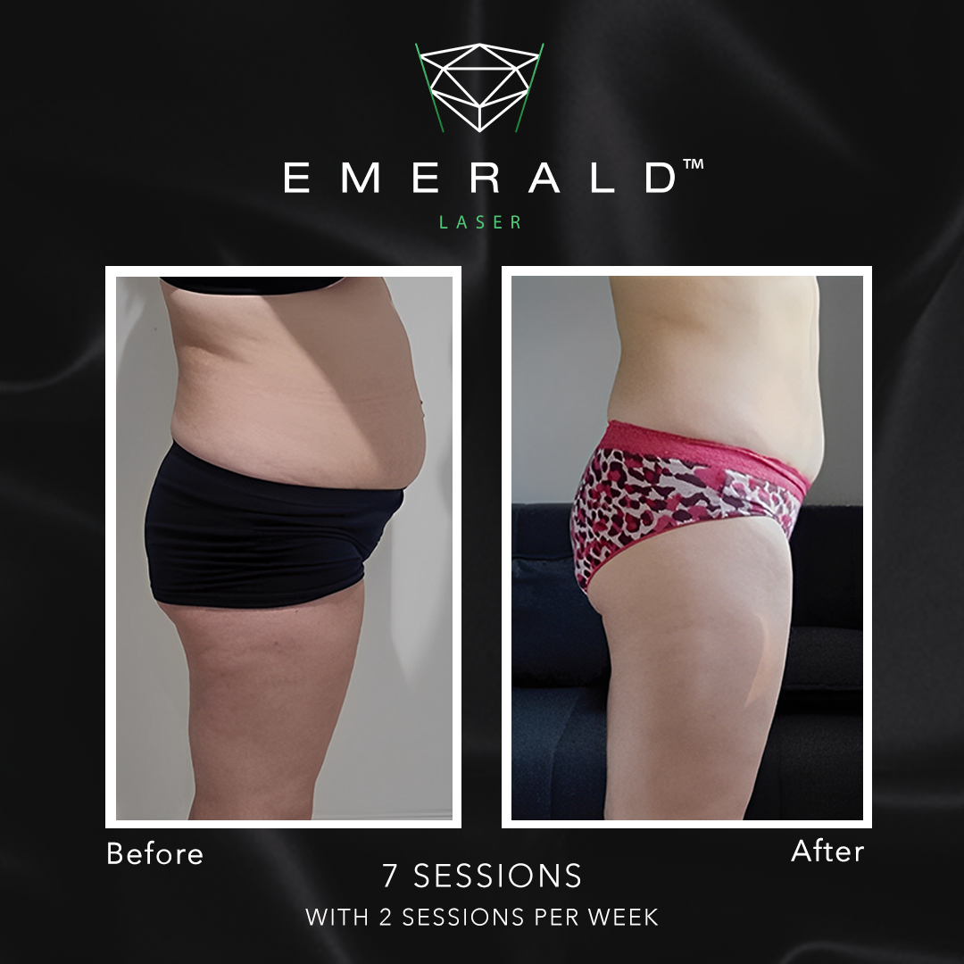 Emerald Fat Loss Laser - Before and After Emerald Fat Loss Laser - Before and After