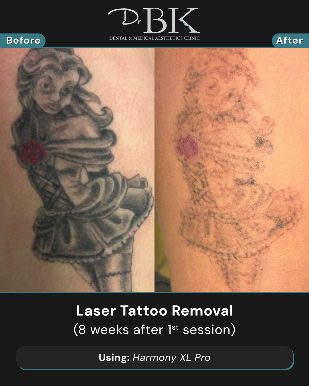 8 weeks after 1st session 8 weeks after 1st session