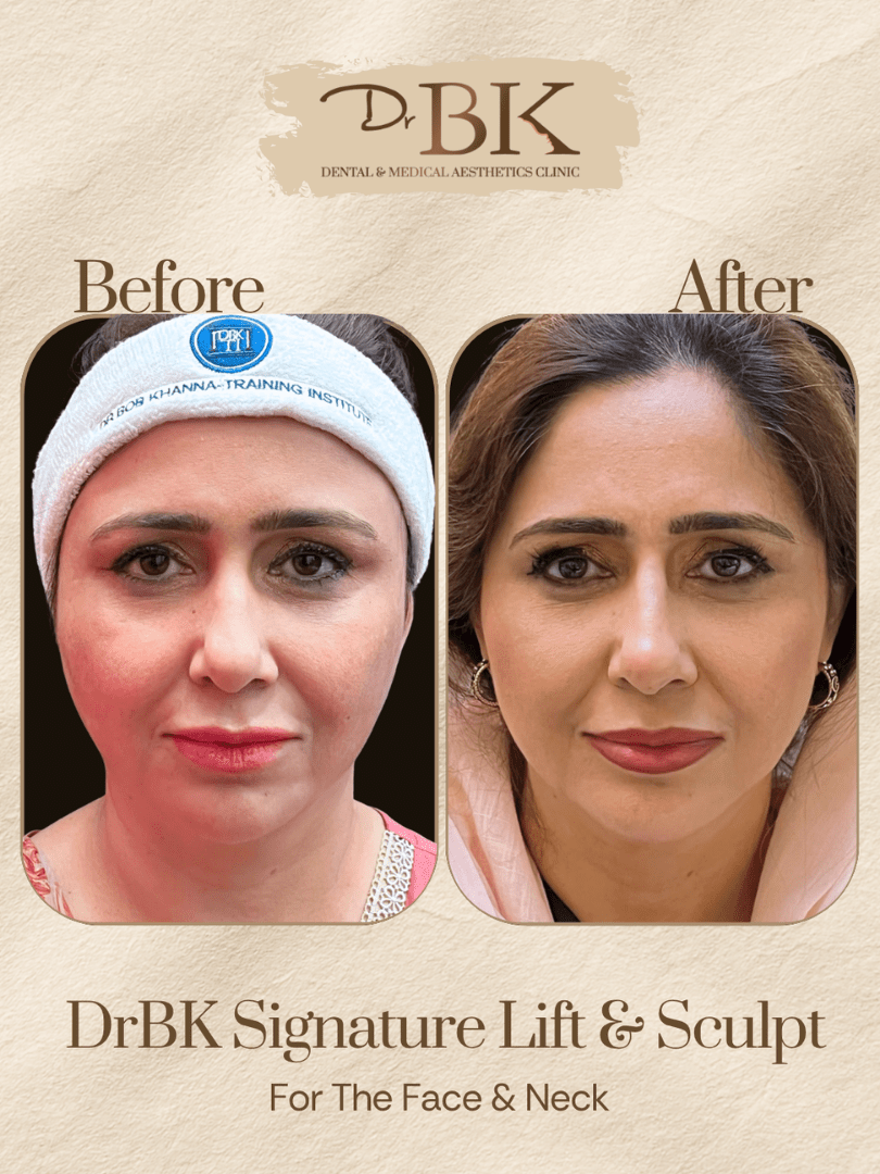 Before and after image of DrBK Signature Non-Surgical Facelift with Threads