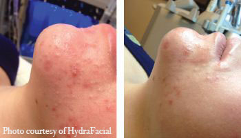 Acne Treatment HydraFacial Before and After 1