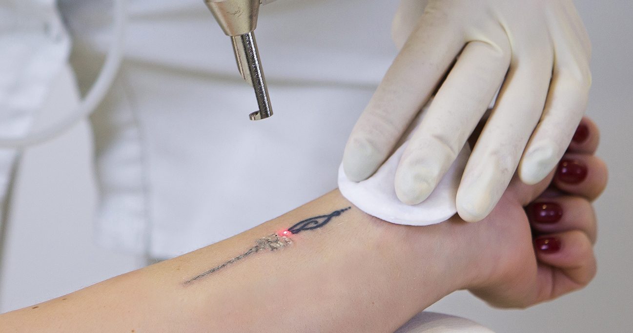 Tattoo Removal Treatments - NALA Institute | Groupon