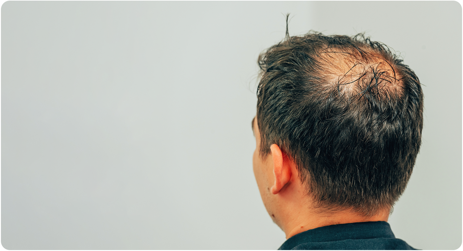 anti hair loss treatment at DrBK Reading