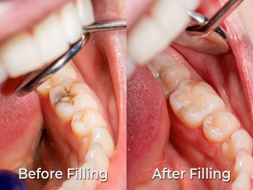 An example of composite fillings at DrBK
