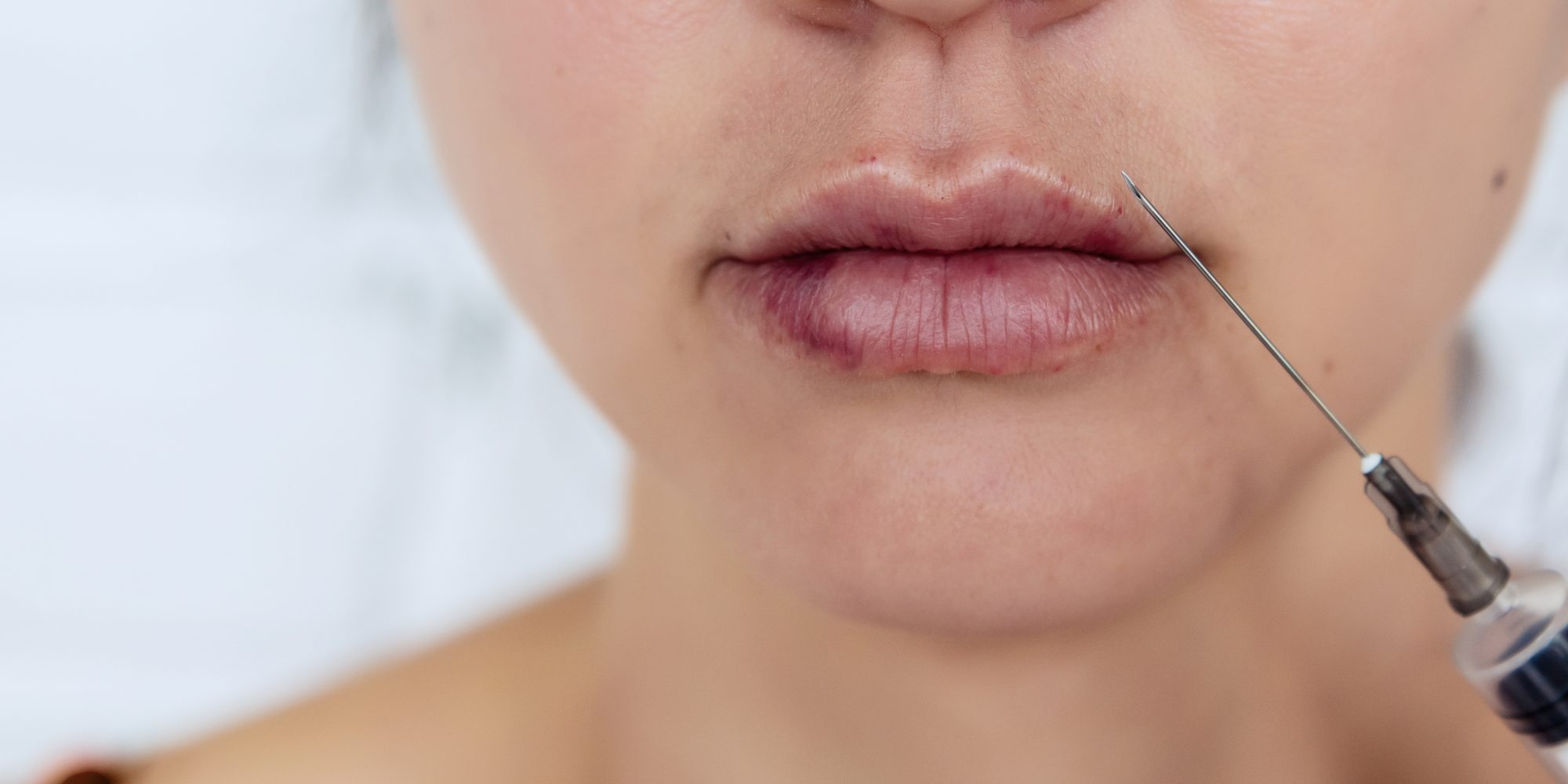 Women's lips after injections of hyaluronic acid. Complications after lip augmentation.