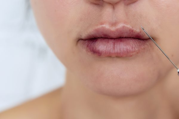 Women's lips after injections of hyaluronic acid. Complications after lip augmentation.