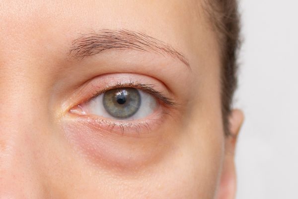 Undereye treatments at DrBK Clinic
