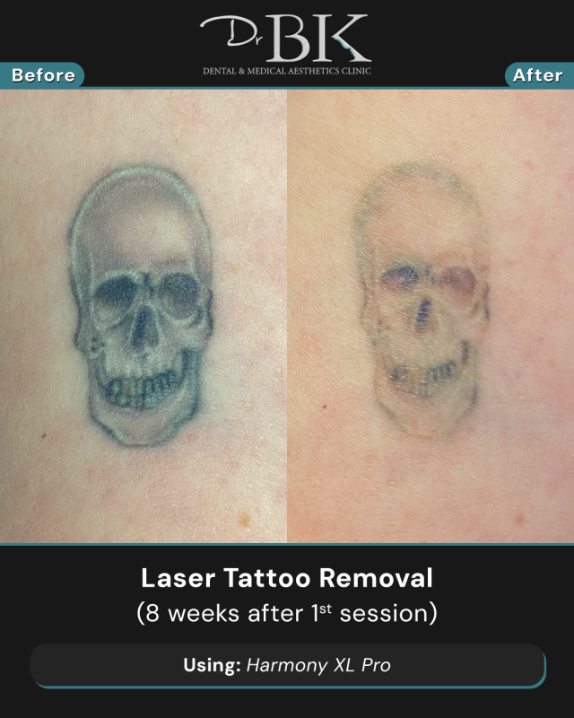 After 1 session After 1 session