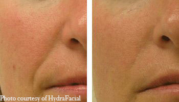 Anti-Ageing-Treatment-Hydrafacial before and after 2