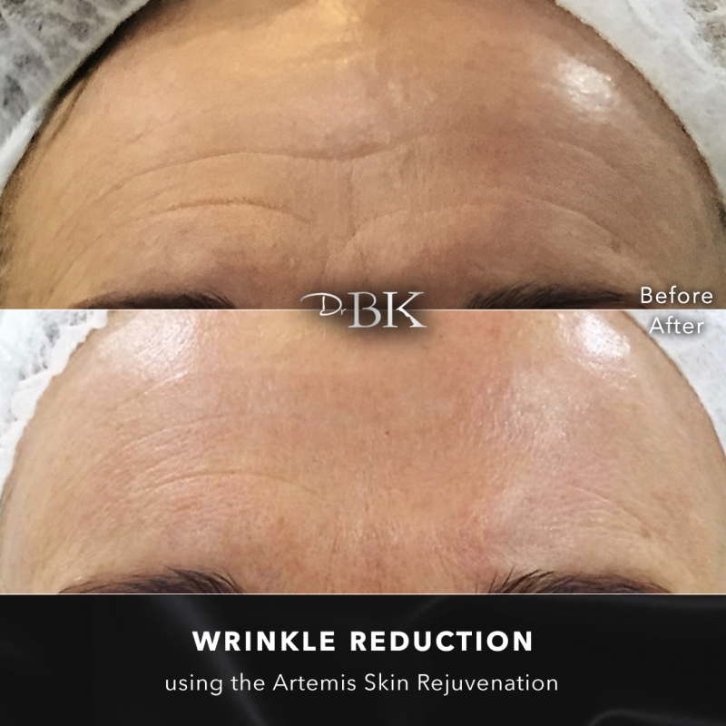 Antiageing - 60 years old, 3 sessions - LIFT & NEEDLE