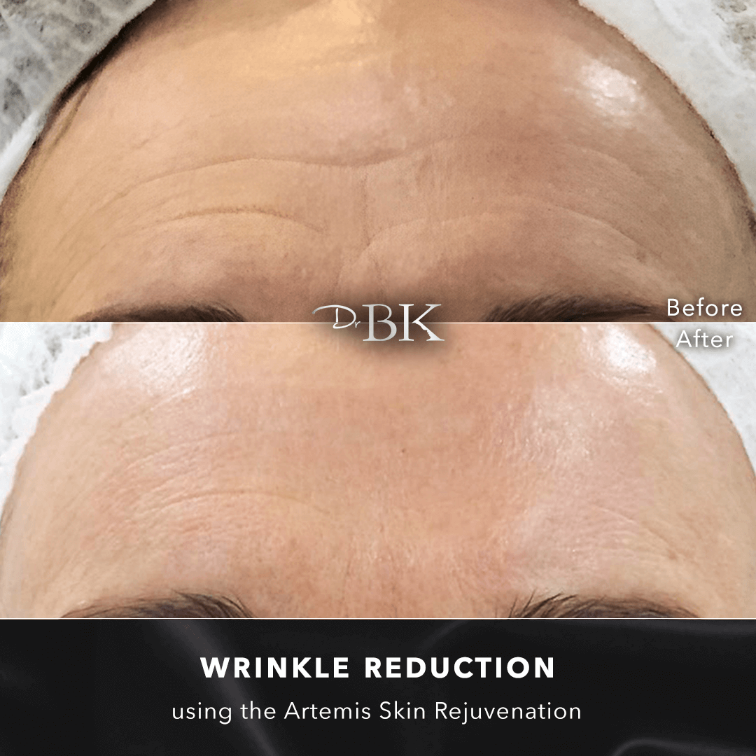 Antiageing - 60 years old, 3 sessions - LIFT & NEEDLE