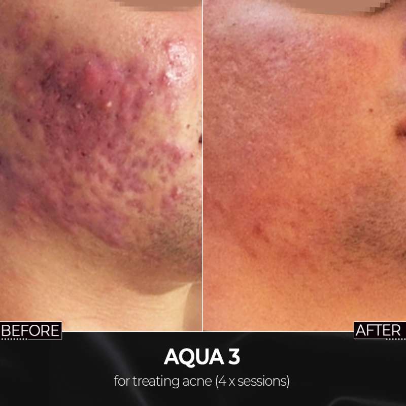Aqua3 - Mesotherapy for acne, stretch marks, skin rejuvenation and more