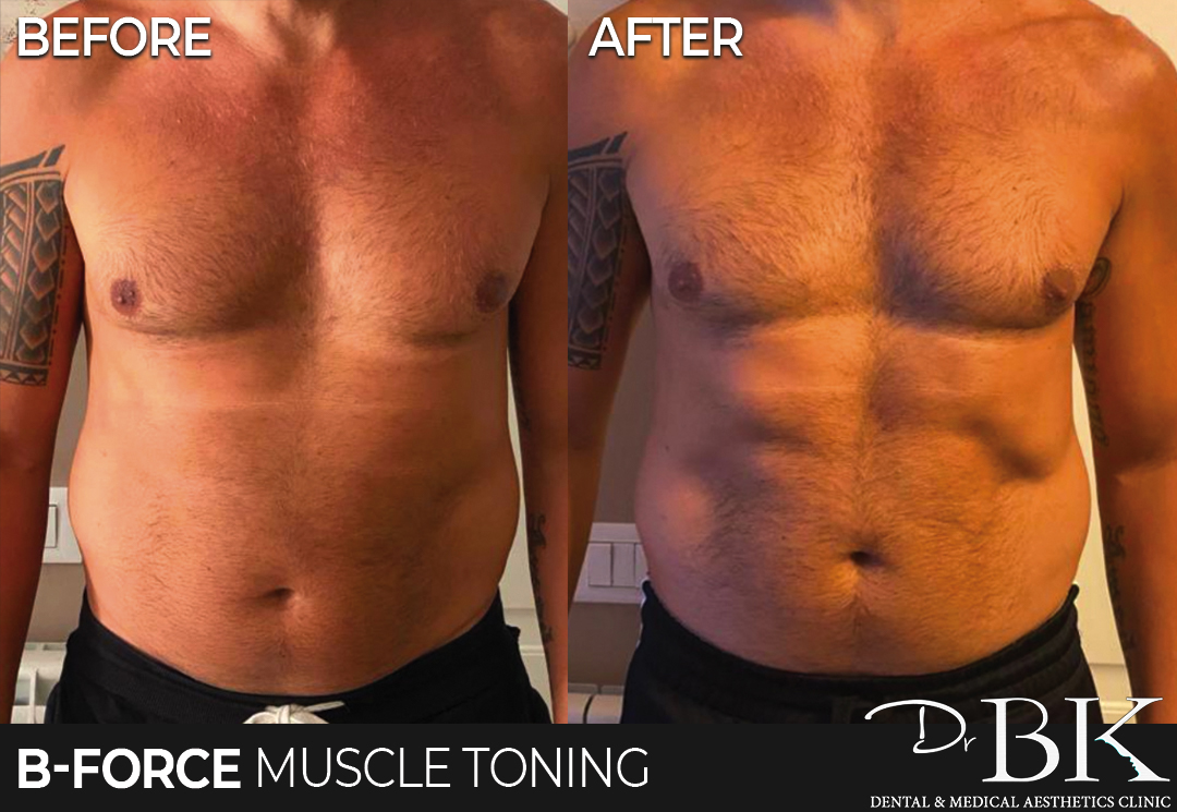 Muscle Toning Treatment - Brand New Body Contouring at the DrBK Clinic