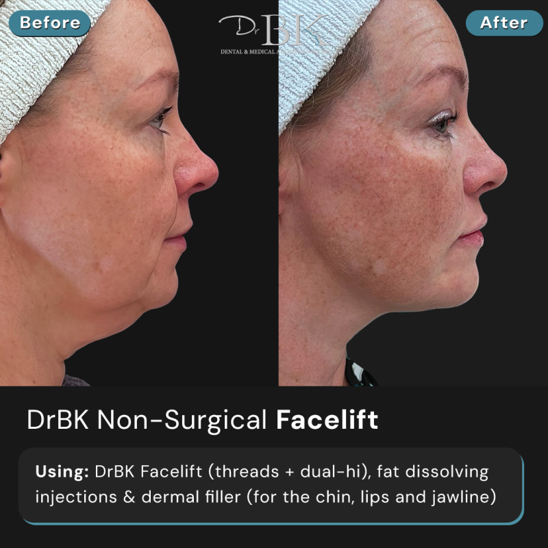 DrBK Facelift (thread lifting and dual-hi) DrBK Facelift (thread lifting and dual-hi)