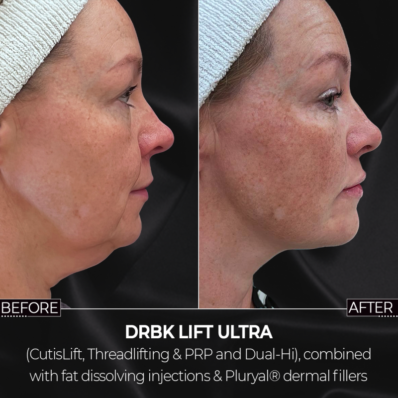 DrBK Lift - with Dual-Hi HIFU treatment DrBK Lift - with Dual-Hi HIFU treatment