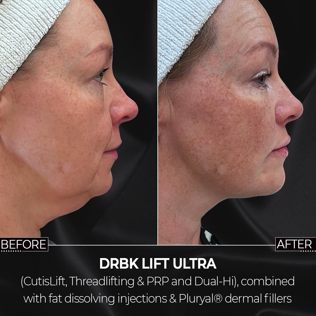 DrBK Lift - with Dual-Hi HIFU treatment DrBK Lift - with Dual-Hi HIFU treatment