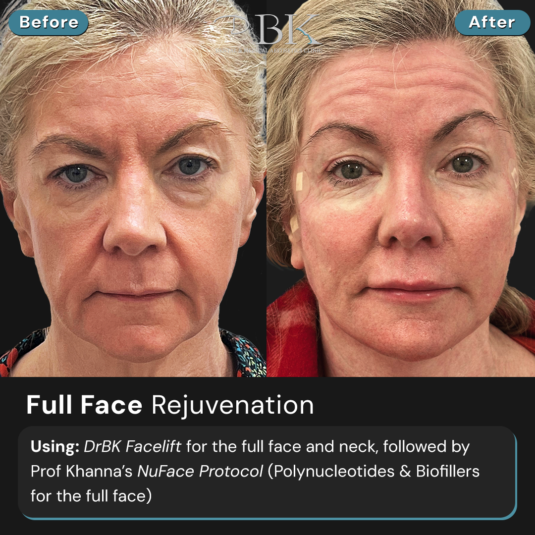 Before and After-Front