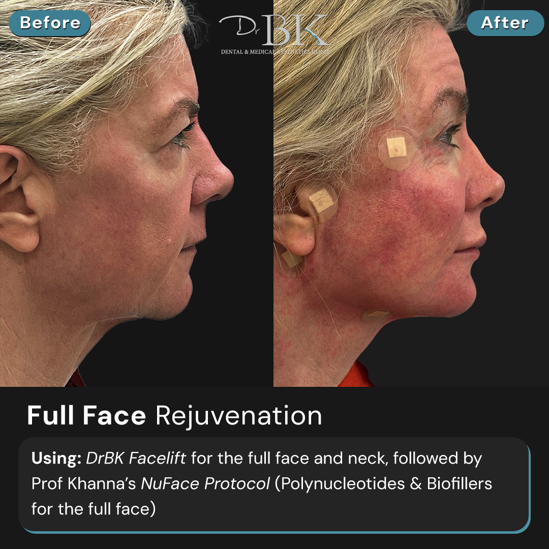 Before and After-Profile1