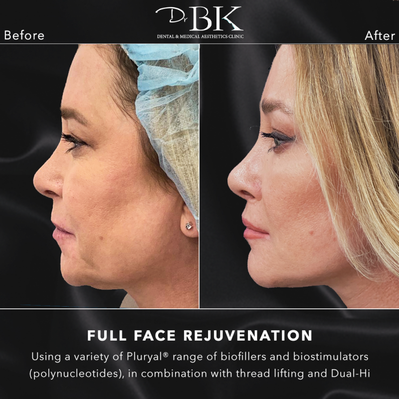 Before and After template1